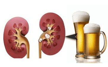 L'effetto dell'alcol sui reni